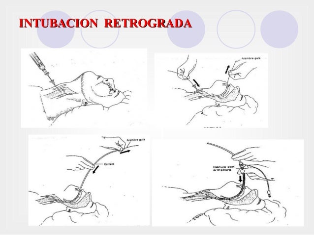 intubacion retrograda